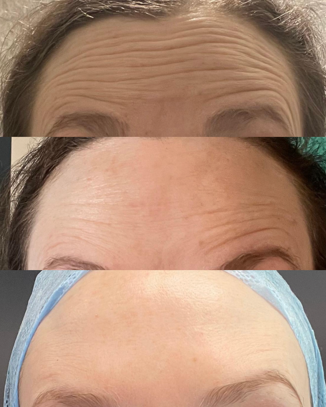 Anti-wrinkle results at The Grange Clinic