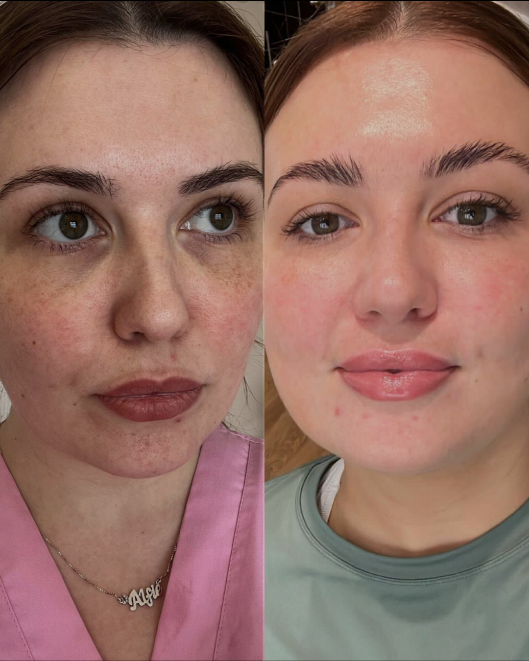 Pigmentation treatment results at The Grange Clinic