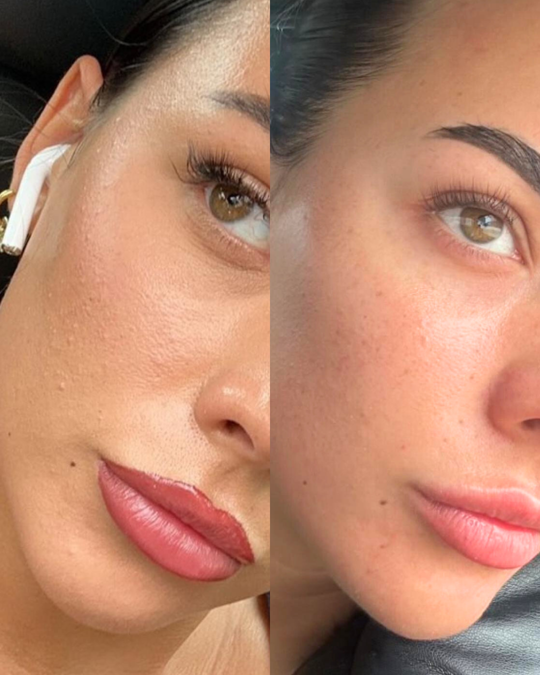 Skin texture treatment results at The Grange Clinic