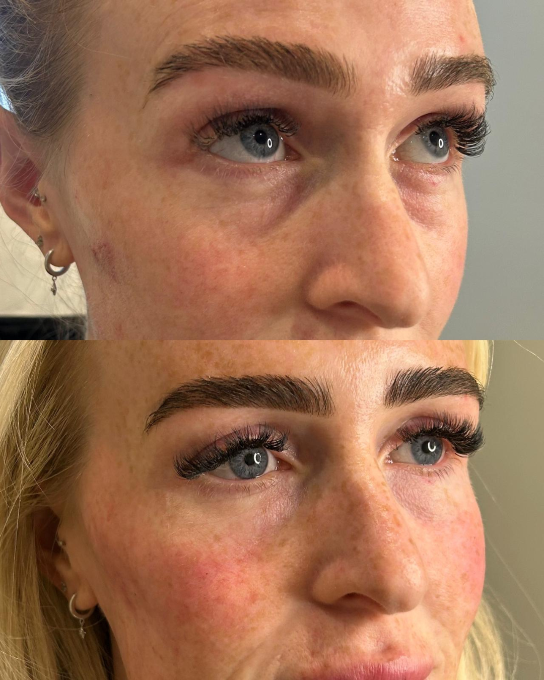 Volume restoration results at The Grange Clinic